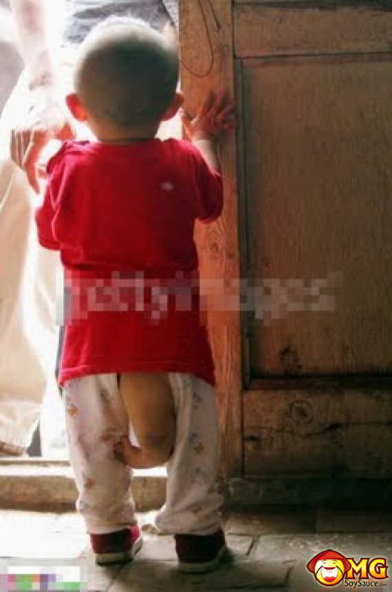 5-3-legged-chinese-asian-boy-kid1.jpg